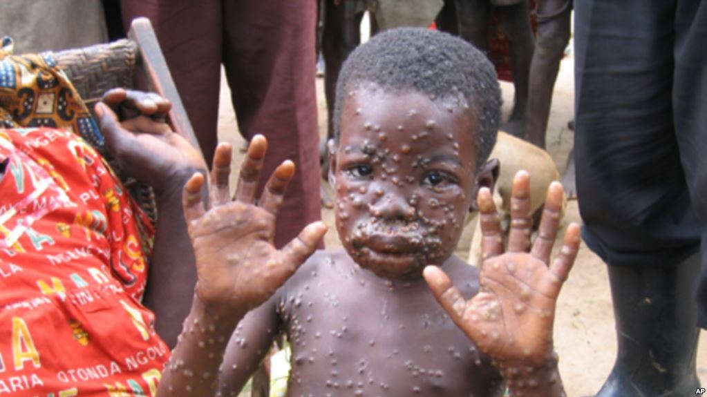 The Nigeria Centre for Disease Control (NCDC) says 31 suspected cases of monkey pox have so far been reported in seven states across the country.