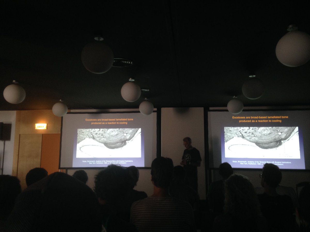 Surfer's Ear by the expert: Dr. Hetzler. Prevention is key! #smi17 #surfingmedicine