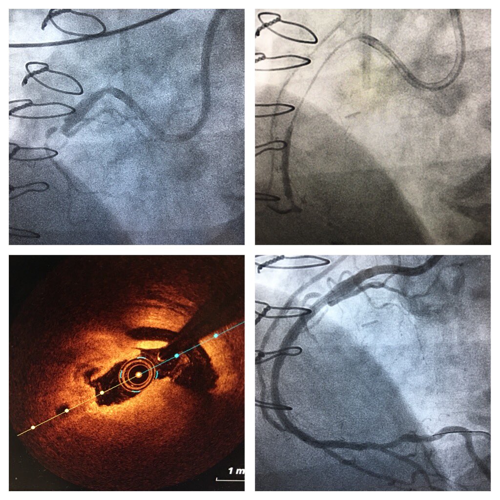 AnkurKalraMD's tweet photo. Dr. Hiram Bezerra #Special; 40-year-old #CABG; failed #ArterialGraft to #RCA; #CTO; #Turnpike; #AWE; #Gaia; #Hornet; #Pilot200; #OCT; 3 #BVS https://t.co/ACxs3KyvMG