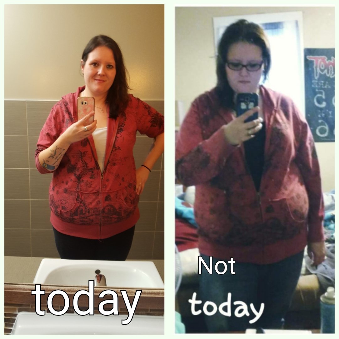 ashmuster's tweet photo. Other pic from almost year ago. Meet surgeon on tues w talk of skin removal 😄😄😄 https://t.co/jJL05uJqiV