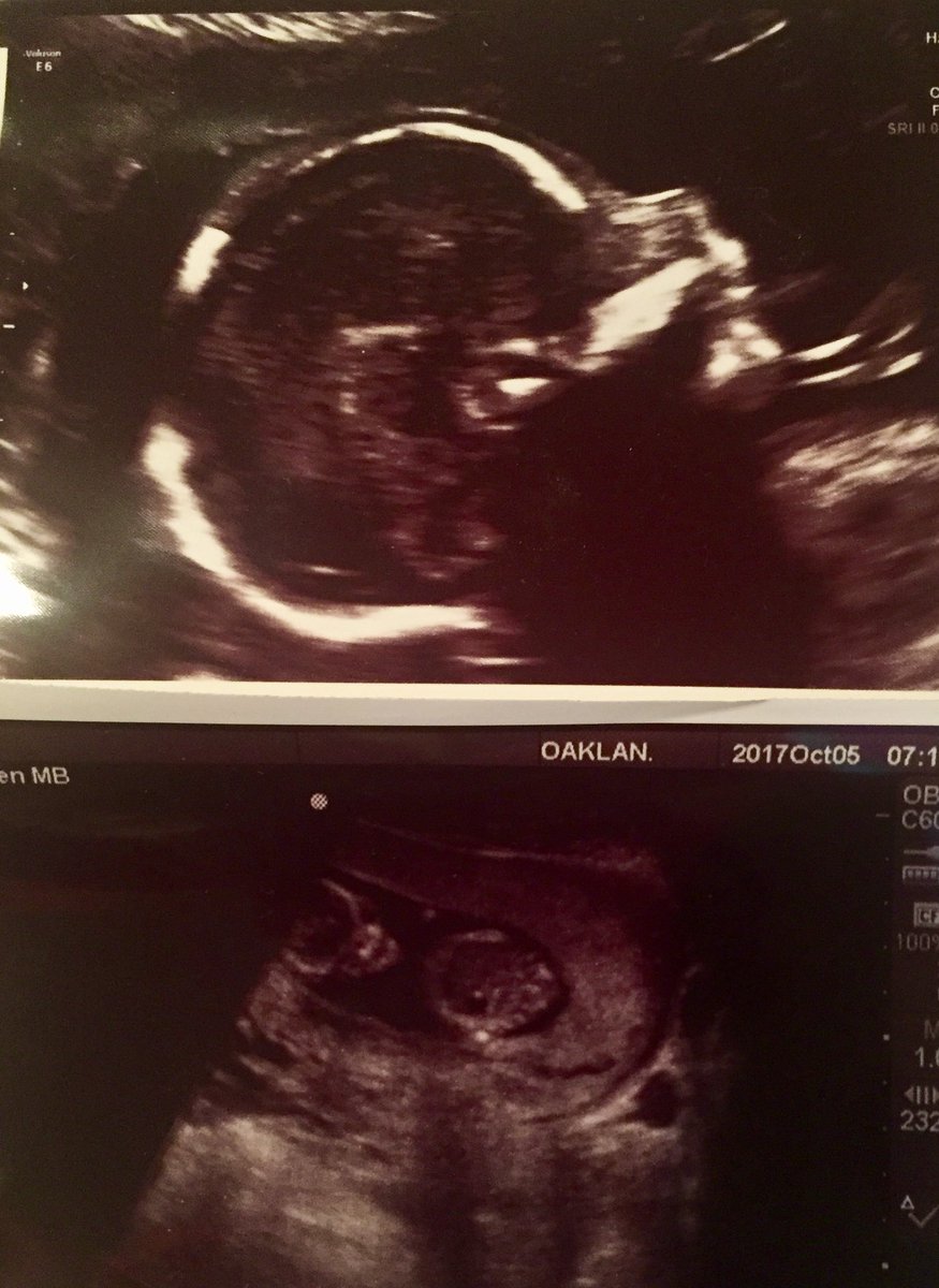 HamLower's tweet photo. Who did it better? Evelyn at 19 weeks (top) or Newest Baby Lower at 13 weeks (bottom)? https://t.co/1h6NmgBbhk