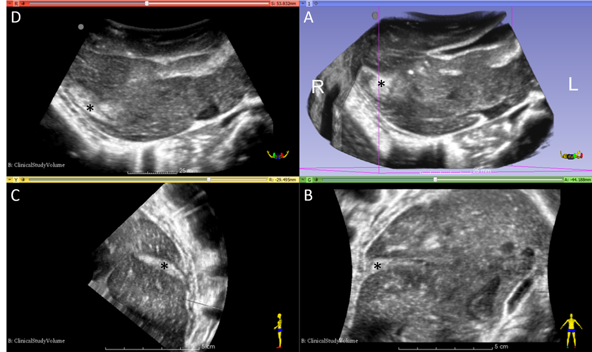 😀Our team was just selected as one of four finalists for the GE/EMF POC US Challenge for our work in 3D ultrasound of traumatic shock.