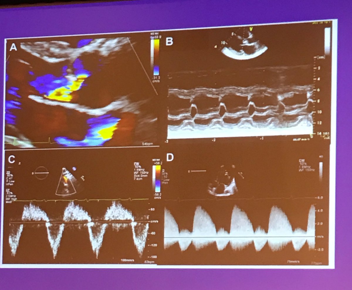 rooshaparikh's tweet photo. Regurgitant valvular disease in a snap shot. Great lecture by @danilov_tatyana #ECHONY2017 @LubbDup @SamRRazaMD @purviparwani @patelapurva https://t.co/nVKL19hYMz