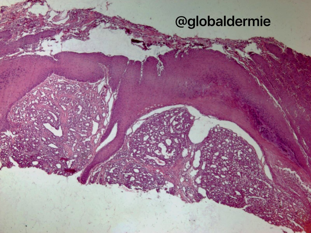 globaldermie's tweet photo. 30yo x5mo. #PyogenicGranuloma (lobular capillary hemangioma) misnomer: neither granulomatous nor infectious #globalderm #pathology #dermpath https://t.co/jeIIw9CL6v