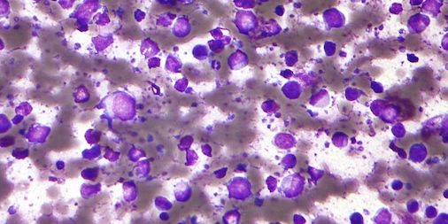 With #wholeexomesequencing and #CRISPR, researchers have revealed more about the #genetic links to #lymphoma buff.ly/2kwAKoH