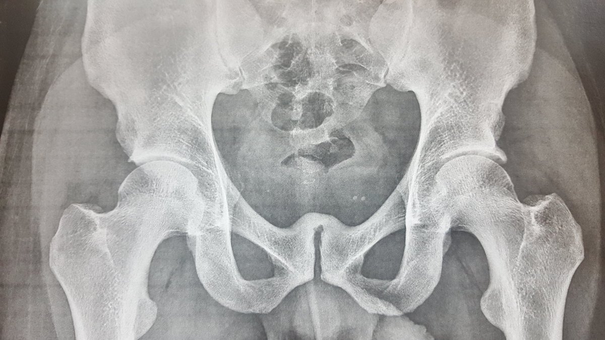 DrSanchezAlepuz's tweet photo. #Osteopatía pubis severa con osificación sinfisis. #Deportista que hace más de 250 #abdominales día. Servicio COT @IMEDHospitales Valencia https://t.co/GhN2FW8zA0