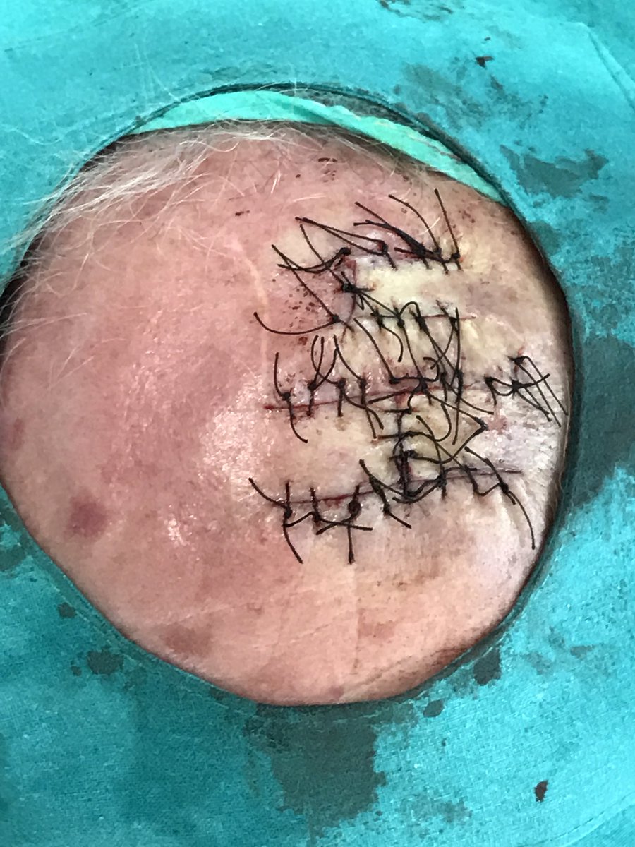 dermacrehuet's tweet photo. #cirugia #dermatologia #Carcinoma #Basocelular #Oncologia #colgajo doble avance + avance simple. Inicio y revisión al mes https://t.co/WqRN8p8QHL