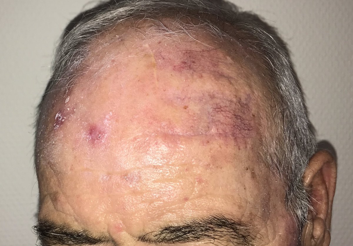 dermacrehuet's tweet photo. #cirugia #dermatologia #Carcinoma #Basocelular #Oncologia #colgajo doble avance + avance simple. Inicio y revisión al mes https://t.co/WqRN8p8QHL