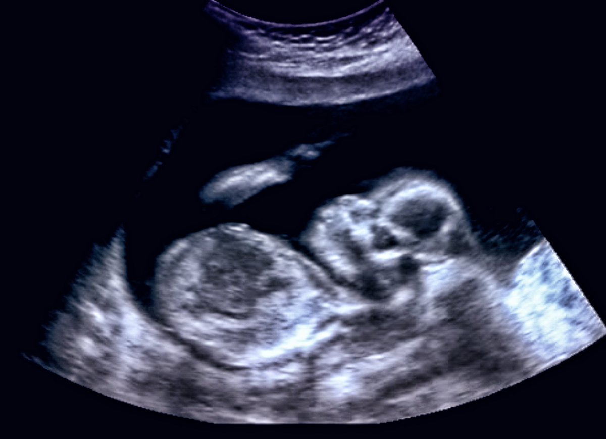 brainpan2015's tweet photo. #Uttarakhand has seen #infant mortalities (#IMR) rise from 34 during the last Sample Registration System (SRS) survey to 38 this year https://t.co/5vvLnri5mJ