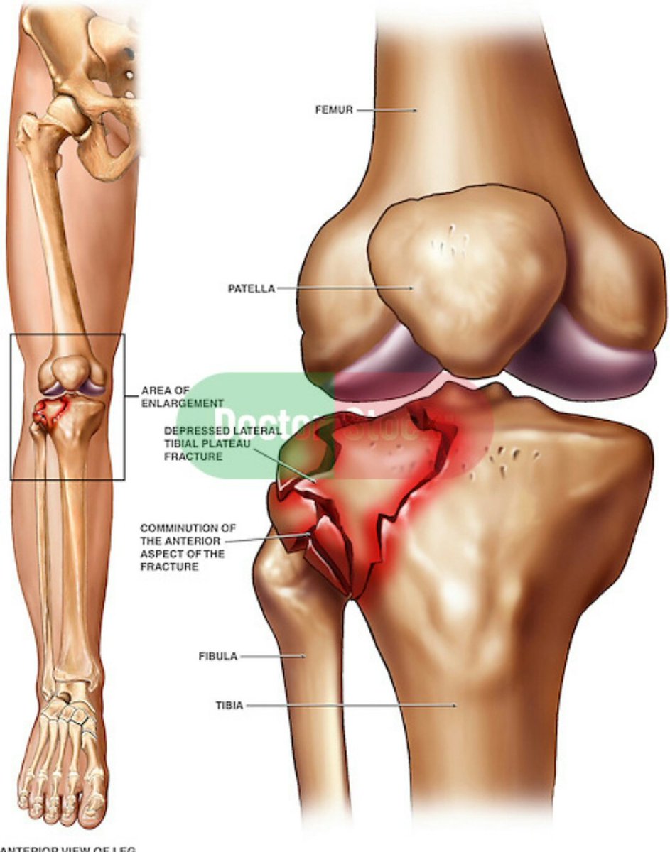 #Texans JJ Watts injury (tibial plateau fracture) .