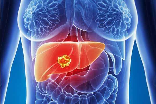 oncologicainfo's tweet photo. Entenda um pouco sobre o hepatocarcinoma https://t.co/5DYQBdYbfI https://t.co/dVd1VVlG1H