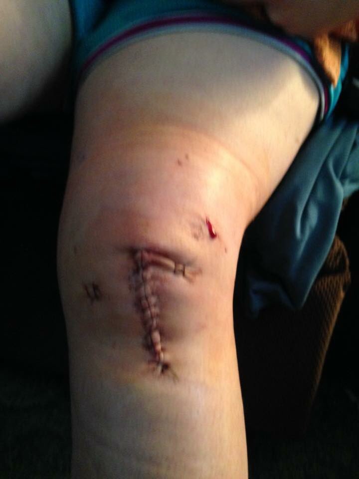 CKintheCC's tweet photo. @JJWatt  I know exactly what u r going through. Tore my ACL 2-steppin w/ an inept partner. ACL reconstruction surgery. U’ll pull through 💋 https://t.co/yGzmHWWGzC