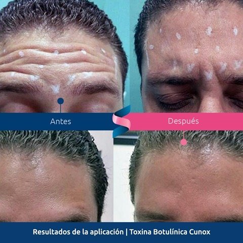 globalskinDOM's tweet photo. Resultados de la Toxina botulínica #Cunox por @dra.tolentinoderma para mejorar la apariencia de las líneas de expresión.
#GlobalSkinDom https://t.co/CxQRBnJdV9