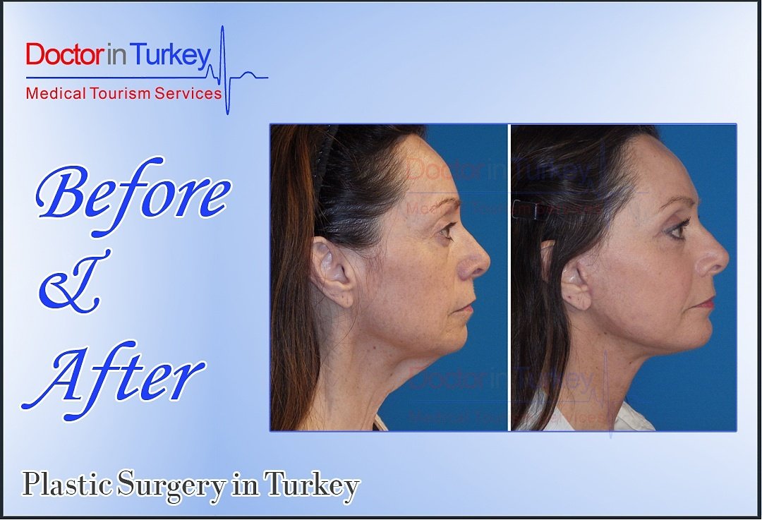 medigance's tweet photo. Did you know ? 
Plastic Surgeries are much cheaper in Turkey with than EU &amp; UK countries🌏

Even with;
+flights🛫 
+accommodation🛏 
+holiday 🌞 https://t.co/RDRg1VRFei