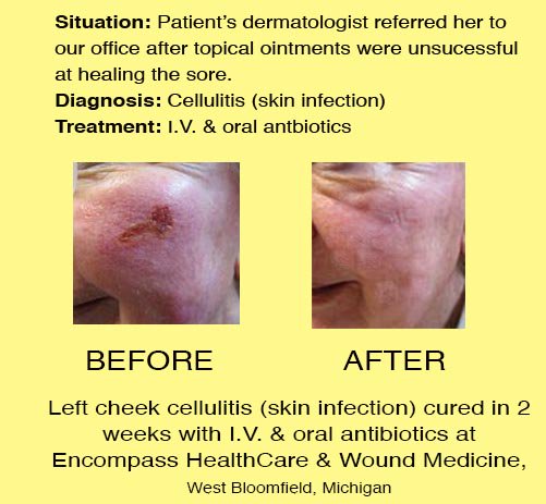 oral antibiotics for skin infections