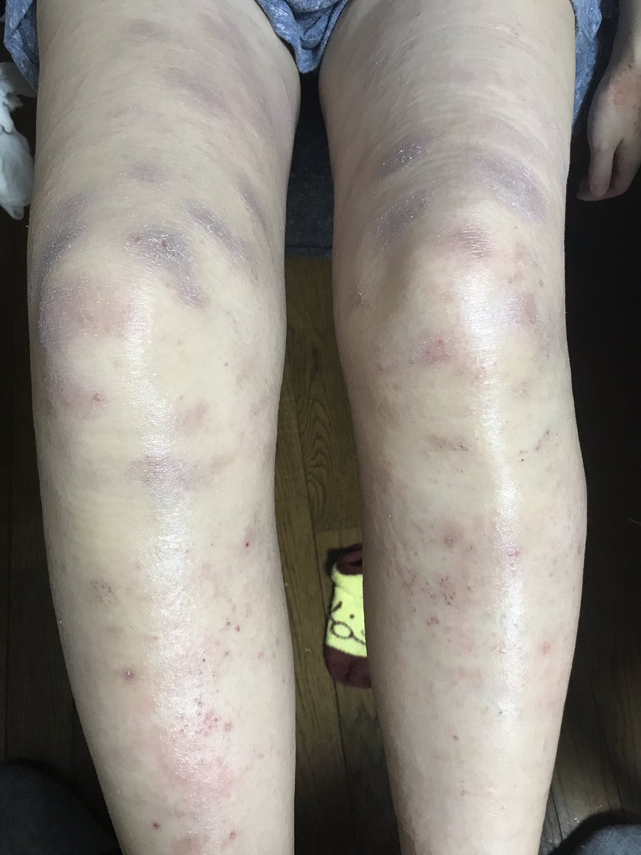 末っ子パンダ 奥さんが貨幣状湿疹を発症してから2週間 毎日の薬の塗布とガーゼを細かく交換する事で少しずつ良くなりました 猛烈な痒みは相変わらずでかなりツライですが とにかくまた2人で色んなスパ施設を巡れるように 奥さんを支えて行きたいと思い