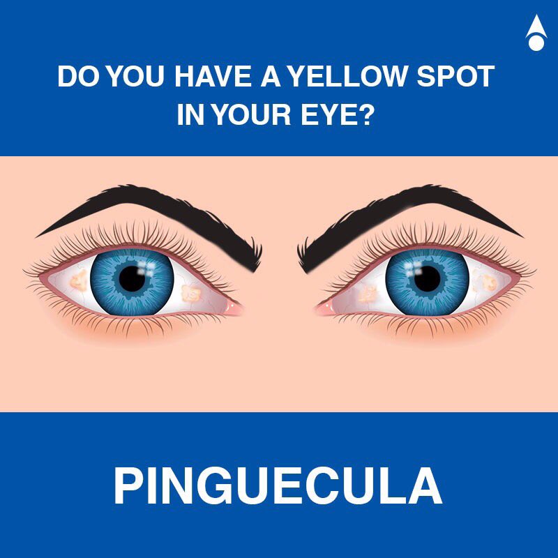 Raised Yellow Spots On Eyeballs Clipart