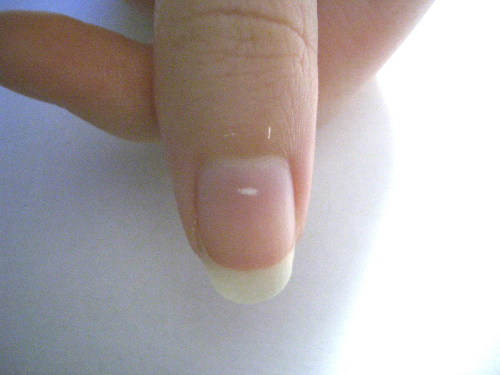 the cause of the white spots on your finger nails