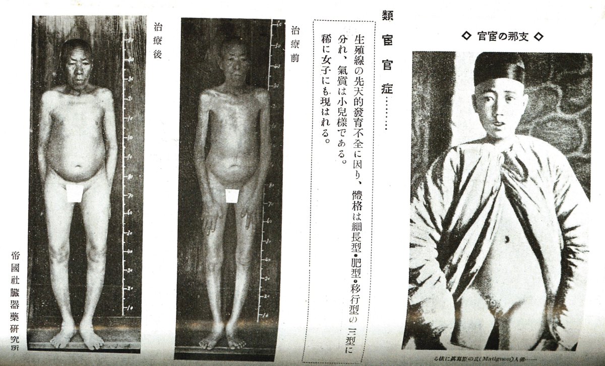 【去勢の歴史】
どちらも非常に有名ですが、衛生展覧会では人為的な去勢と類宦官症患者の写真等が紹介されていました
#衛生展 