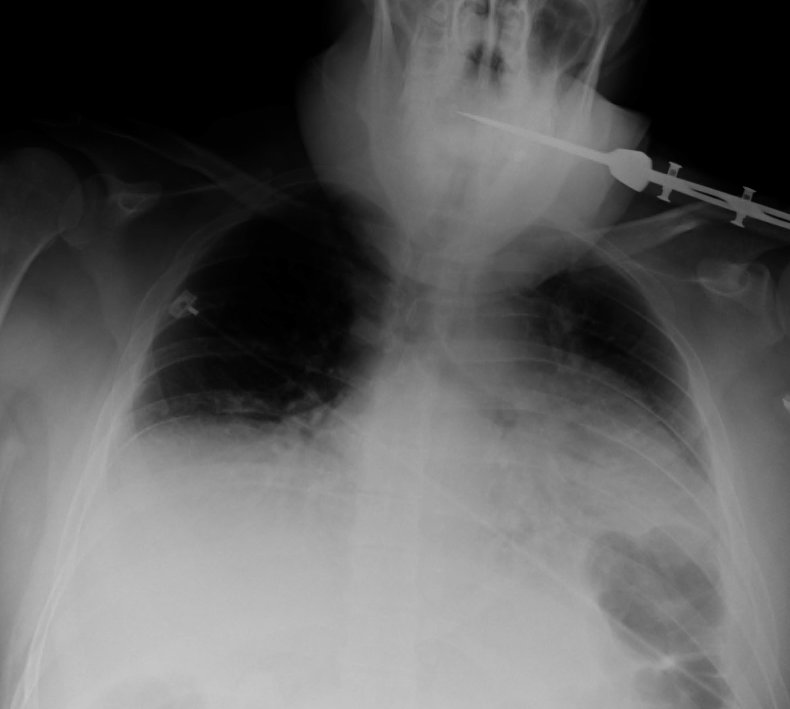 Penetrating Neck Trauma, a zone-less algorithm #FOAMed ddxof.com/penetrating-ne…