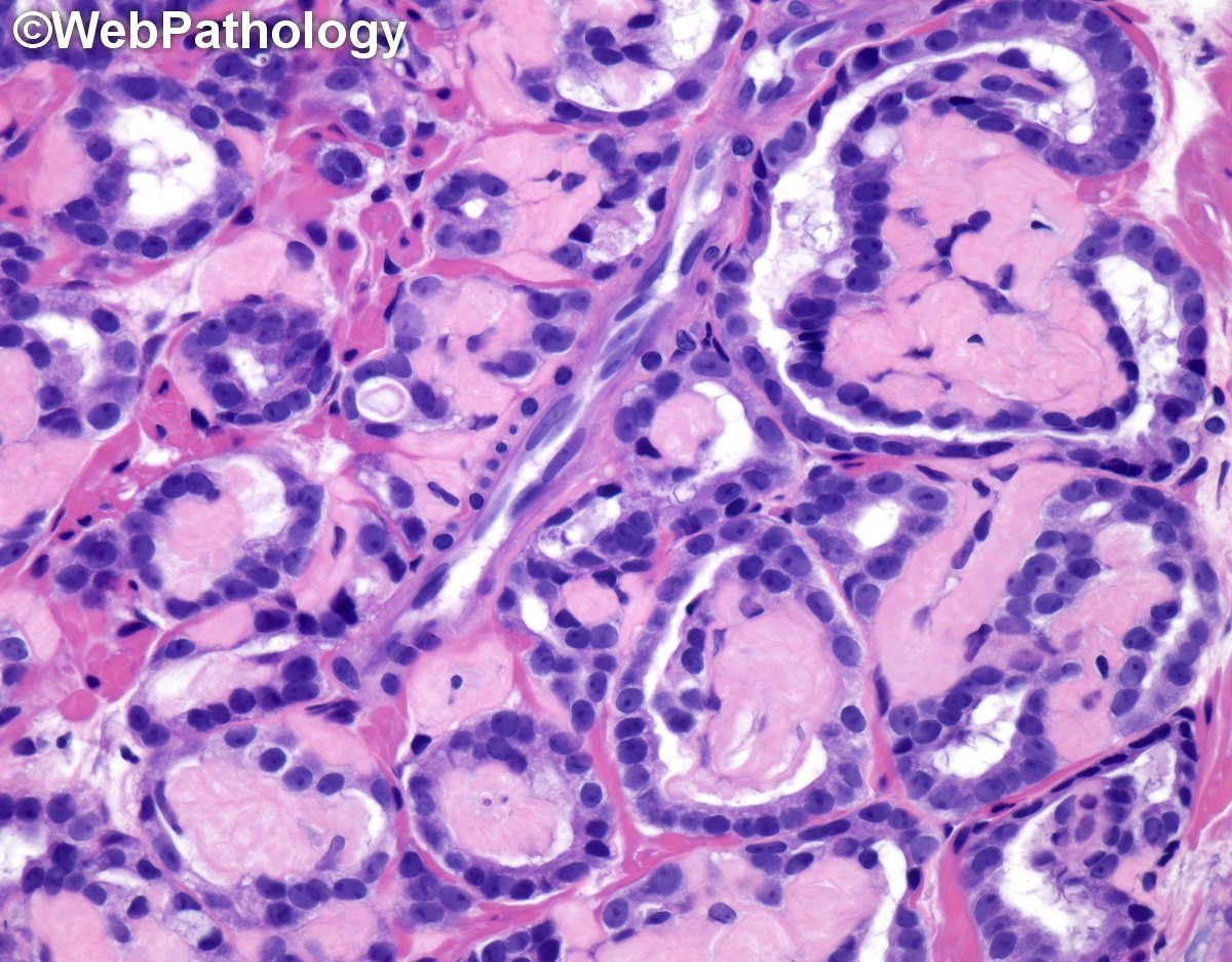 WebPathology (@webpathology) on Twitter photo Classic example of collagenous micronodules (aka mucinous fibroplasia) in #prostatecancer #GUPath #pathologists <a href="/Pathologists/">CAPathologists</a> Classic example of collagenous micronodules (aka mucinous fibroplasia) in #prostatecancer #GUPath #pathologists <a href="/Pathologists/">CAPathologists</a>