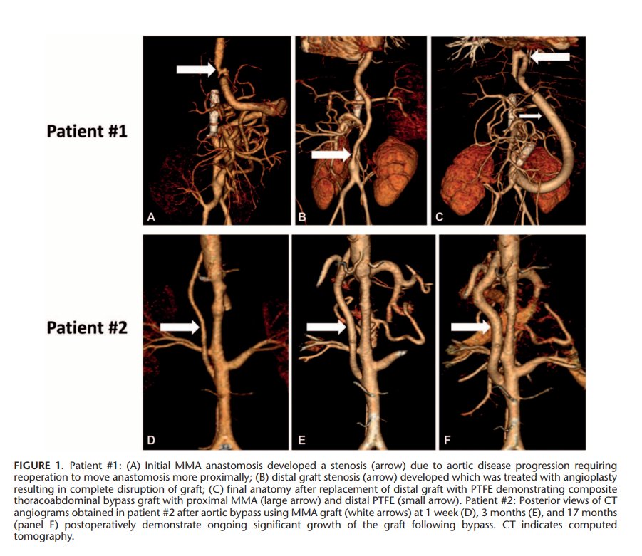 Mesenteric Artery Growth Improves Circulation (MAGIC) in Midaortic Syndrome. bit.ly/2hAyaJp