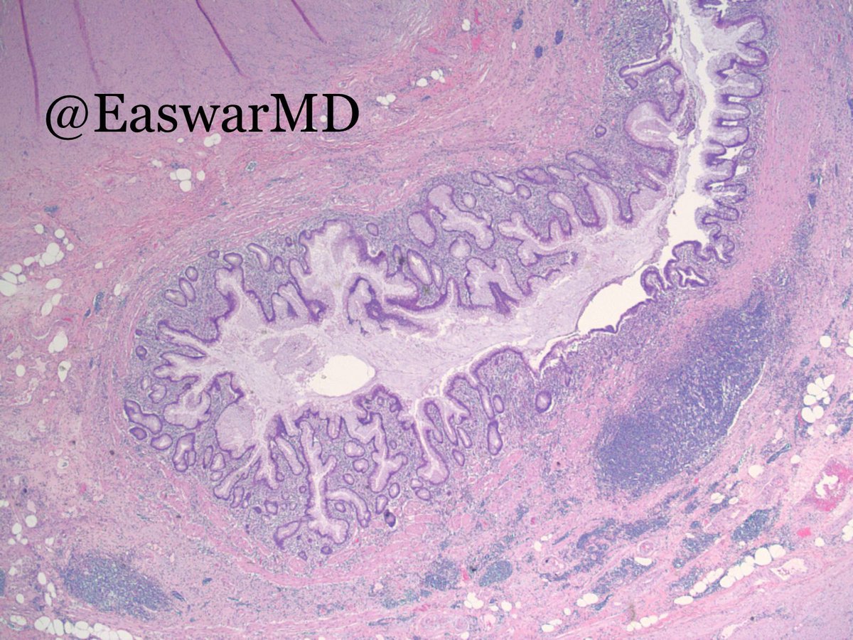 EaswarMd's tweet photo. Low grade appendiceal mucinous neoplasm (LAMN): extravasation of acellular mucin with cystic dilation of lumen, low grade cytologic atypia https://t.co/l4dbKjxoMV