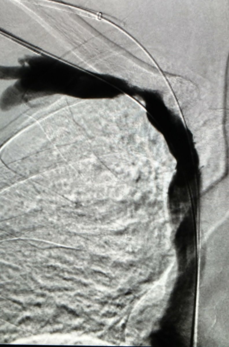 LessneVIR's tweet photo. Swelling w AVF. #IRad #wecanrecan + #AVLutonix. But should we be thinking rib resection in these pts?? @mcbreamy https://t.co/NSWPYC4fcs