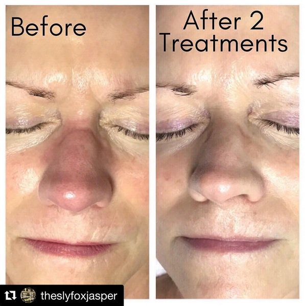 SkinCareCRL's tweet photo. https://t.co/yE5c7Iqm2I 😻 .@theslyfoxjasper "We are finally settling in and going back to what we love. Here are some #BeforeAndAfter pictures of our #Microneedling." #ClinicalResolution #SkinCareCRL #InnoPen #MTSRoller #NumbMaster #Facials #Spas #USA21 https://t.co/3EpvCXt2IY