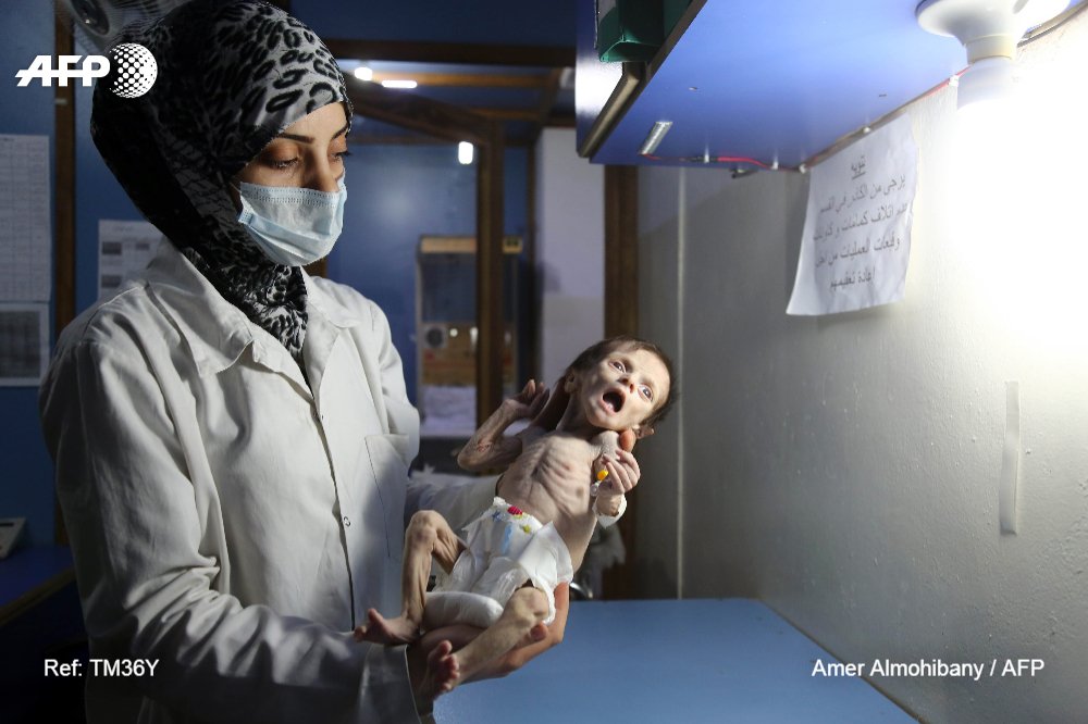 afpfr's tweet photo. Syrie : dans la Ghouta assiégée, la mort rôde autour d'enfants malnutris https://t.co/a3SUwY3Iub par @amer_almohibany #AFP https://t.co/I813XI5BJy