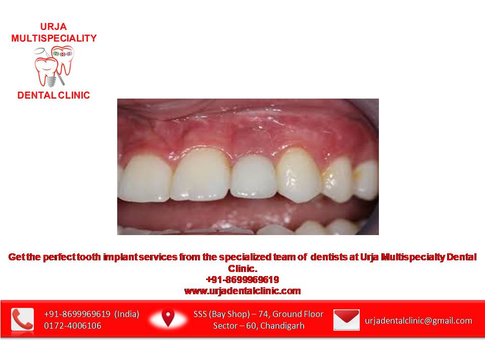 india_dental's tweet photo. #toothimplant #dentalimplantcost #dentureimplants #toothimplantcost #dentalimplants
+91-8699969619
https://t.co/nUaJgp5tZo https://t.co/pvqhZeMeC9