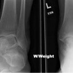 sportsfootankle's tweet photo. Is #anklepain stopping you? STAR #anklereplacement could be the right option for you. Learn if you are a candidate https://t.co/HbXz02APg0 https://t.co/qnm8qRHSIM