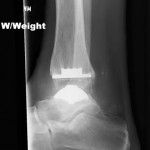 sportsfootankle's tweet photo. Is #anklepain stopping you? STAR #anklereplacement could be the right option for you. Learn if you are a candidate https://t.co/HbXz02APg0 https://t.co/qnm8qRHSIM