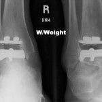 sportsfootankle's tweet photo. Is #anklepain stopping you? STAR #anklereplacement could be the right option for you. Learn if you are a candidate https://t.co/HbXz02APg0 https://t.co/qnm8qRHSIM