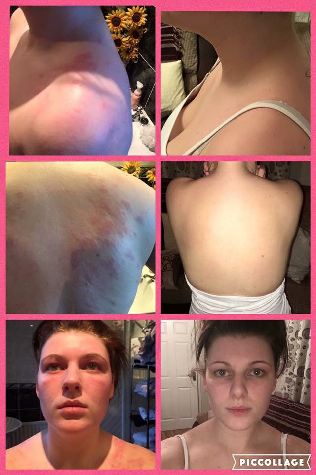 JessBowler2's tweet photo. Skin results 🙌🏼 goodbye itchy and painful psoriasis ✋🏼👏🏼😍 who could use some of our magic beans? 🙋🏼🙋🏼🙋🏼 https://t.co/RKVM8C0n51