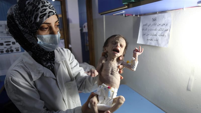 AJEnglish's tweet photo. "One in four children suffers from malnutrition."
Syrian children's hunger crisis worsens in east Ghouta https://t.co/sIaBjPhwlj https://t.co/4KYVKSt0dF