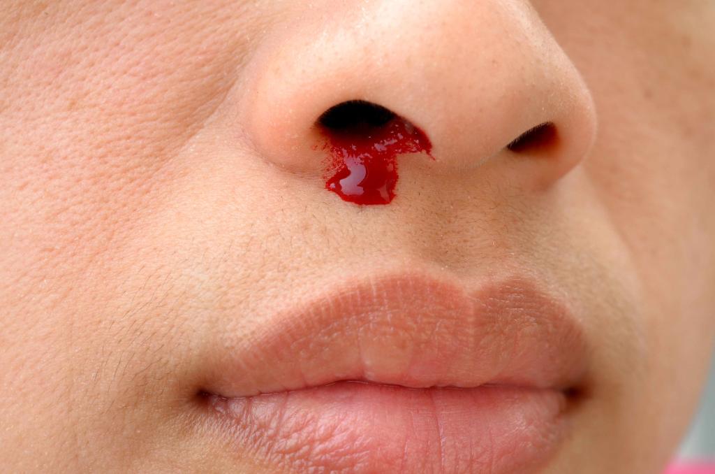 #HomeRemedies: How to stop a #nosebleed in 4 steps. mayocl.in/2gDdZOw