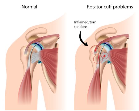 Acupuncture_T's tweet photo. Types Of Shoulder Pain That #Acupuncture Treatment Can Relieve
https://t.co/FCzo00OYbu https://t.co/8T60bMHDMi