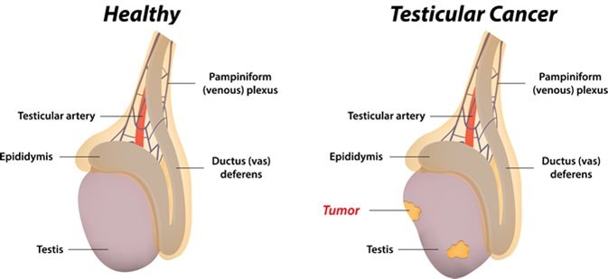 endocrine15's tweet image. #Testicularcancer is cancer that develops in the #testicles, a part of the #malereproductivesystem|imedpub.com/reports-in-end…