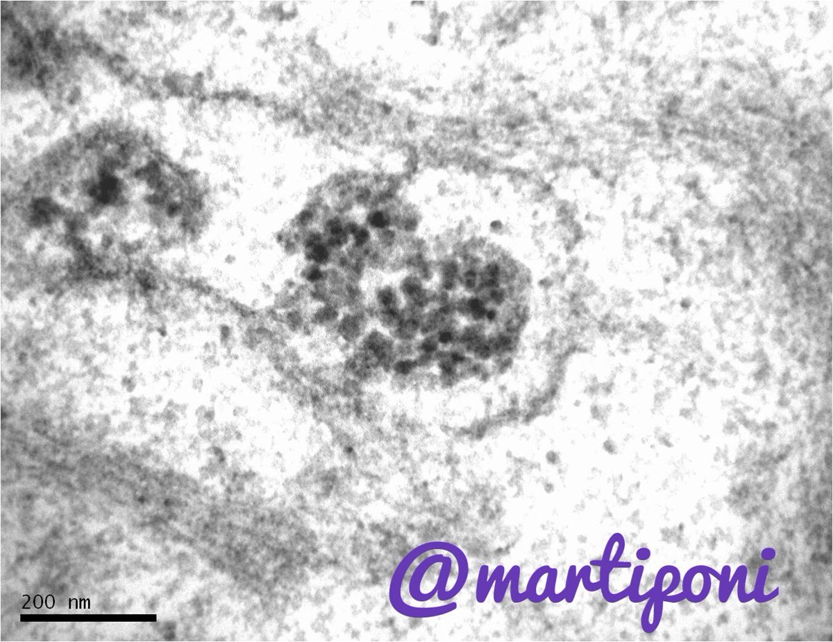 Virus particles (40 nm) inside vesicles in placenta infected by ZICA #ElectronMicroscopy #PediPath