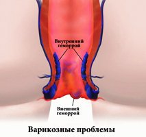 med_informs's tweet photo. Методы оперативного лечения геморроя https://t.co/0Qp1jWMD8I https://t.co/cEqAX9fWBv