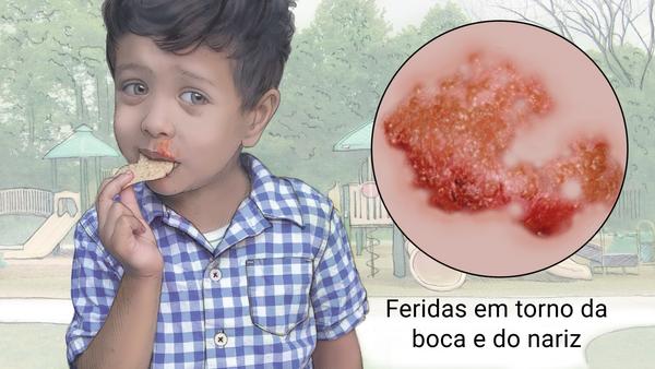 alomaesp's tweet photo. Impetigo (ou impinge) 👦👶👧
Você sabe sabe o que impetigo e o que causa?
Acesse👉https://t.co/xllpxfMZmM
#Impetigo #impinge #programaalomae https://t.co/NbO5yGCr28