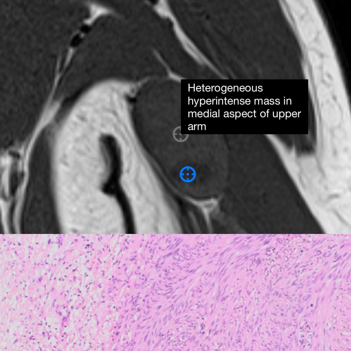 BoSTT_app's tweet photo. Case 70 up! Yes, 70 cases to enjoy @BoSTT_app #pathology #MSKradiol #radiology #softtissue #softtissuepath #MSK https://t.co/YweMlc8j6K