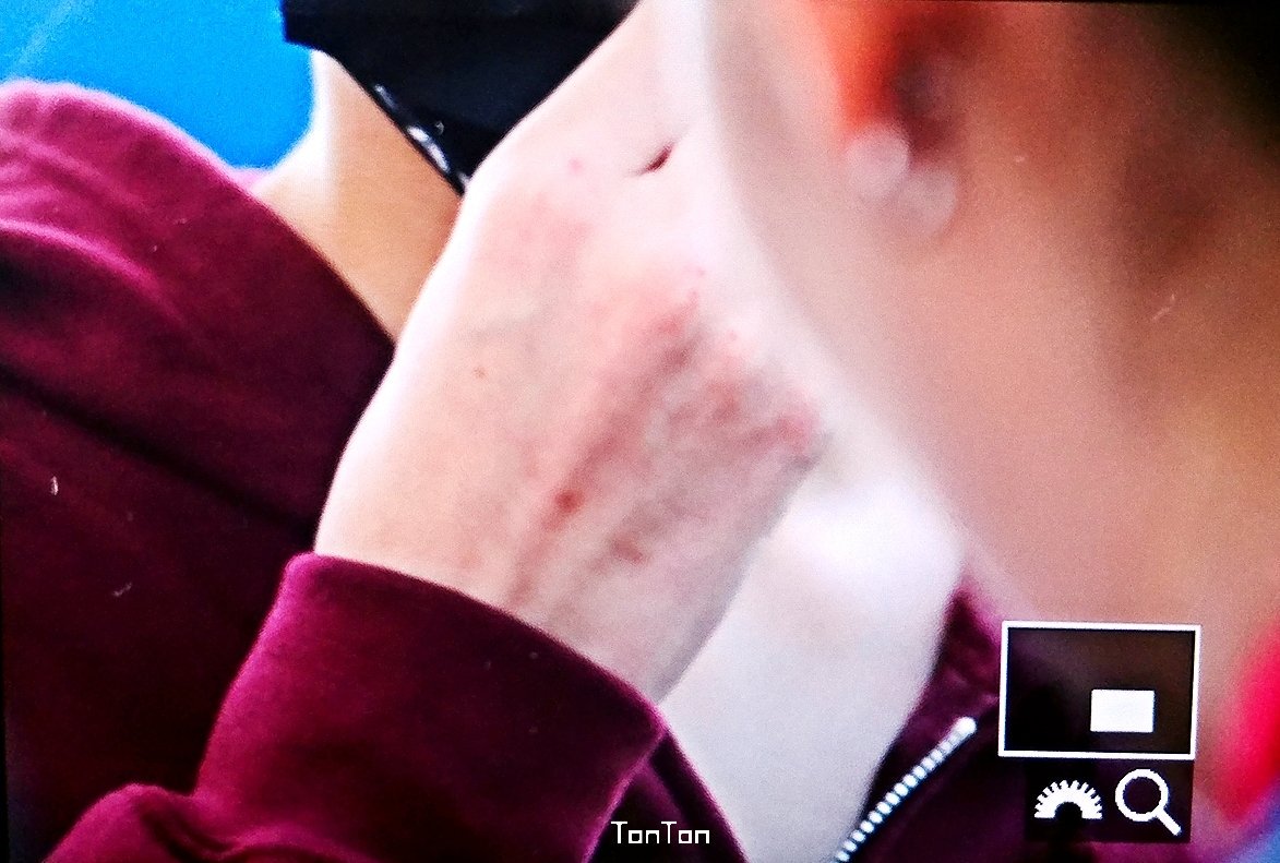 YM_C_bal's tweet photo. 아니 얘 상태가 어떤데 어디가 아프고 얼마나아픈데 그리고 니넨 왜 이걸 입꾹 다물고 있는데 ㅋㅋㅋㅋㅋㅋ1000억 벌고 싶냐 ? 돈 쳐발쳐발해주면 적어도 아티스트 보호는 제대로 해야지 ^^ 
#YMC_라이관린부상_피드백해 진짜이번에 똑바로 피드백해라 ; https://t.co/vQ0Ka9Ts5i