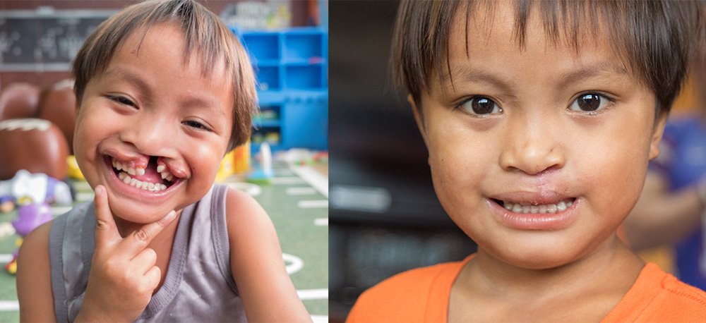 Remember JB? Here's his smile reconstructed! And it's all possible because of you! #TransformationTuesday hubs.ly/H08-X8c0