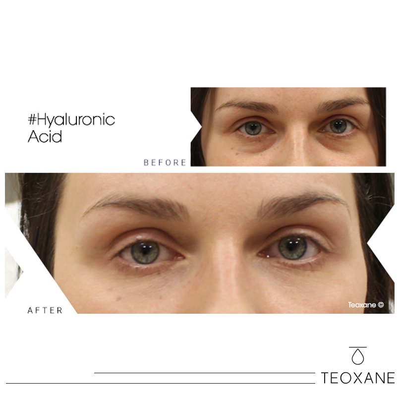 TeoxaneLebanon's tweet photo. Hyaluronic acid injections are your best bet for erasing under-eyes circles even stubborn ones!#Teosyal #BeforeAfter #Filler #DermalFillers https://t.co/vlxylMfCRF