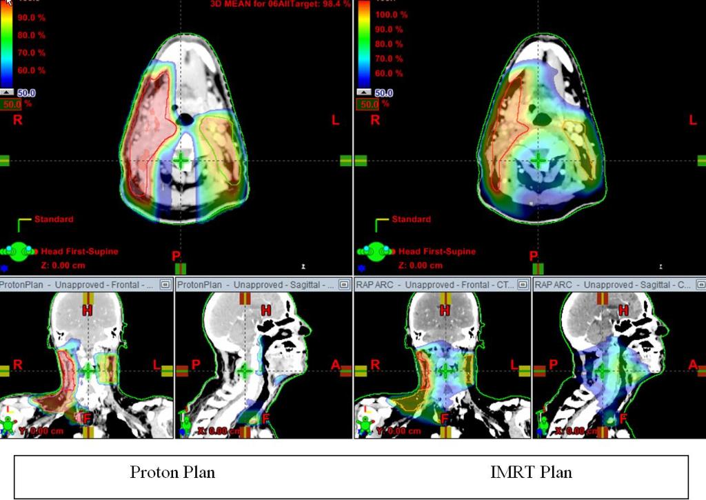 Mayo Clinic Studies (@mayostudies) on Twitter photo Proton beam therapy being used for head/neck #cancer #clinicaltrial. mayocl.in/2yynbsf Proton beam therapy being used for head/neck #cancer #clinicaltrial. mayocl.in/2yynbsf
