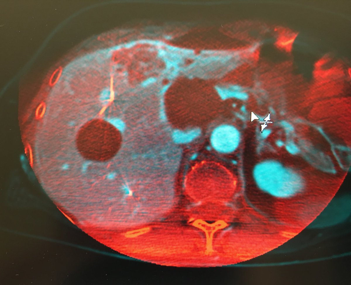 fermgmez's tweet photo. Ablation guidance #XPerCT and image overlay @SJDbarcelona_es @SJDbarcelona_ca @PhilipsSpain @PhilipsHealth https://t.co/KAPE3Q2V93