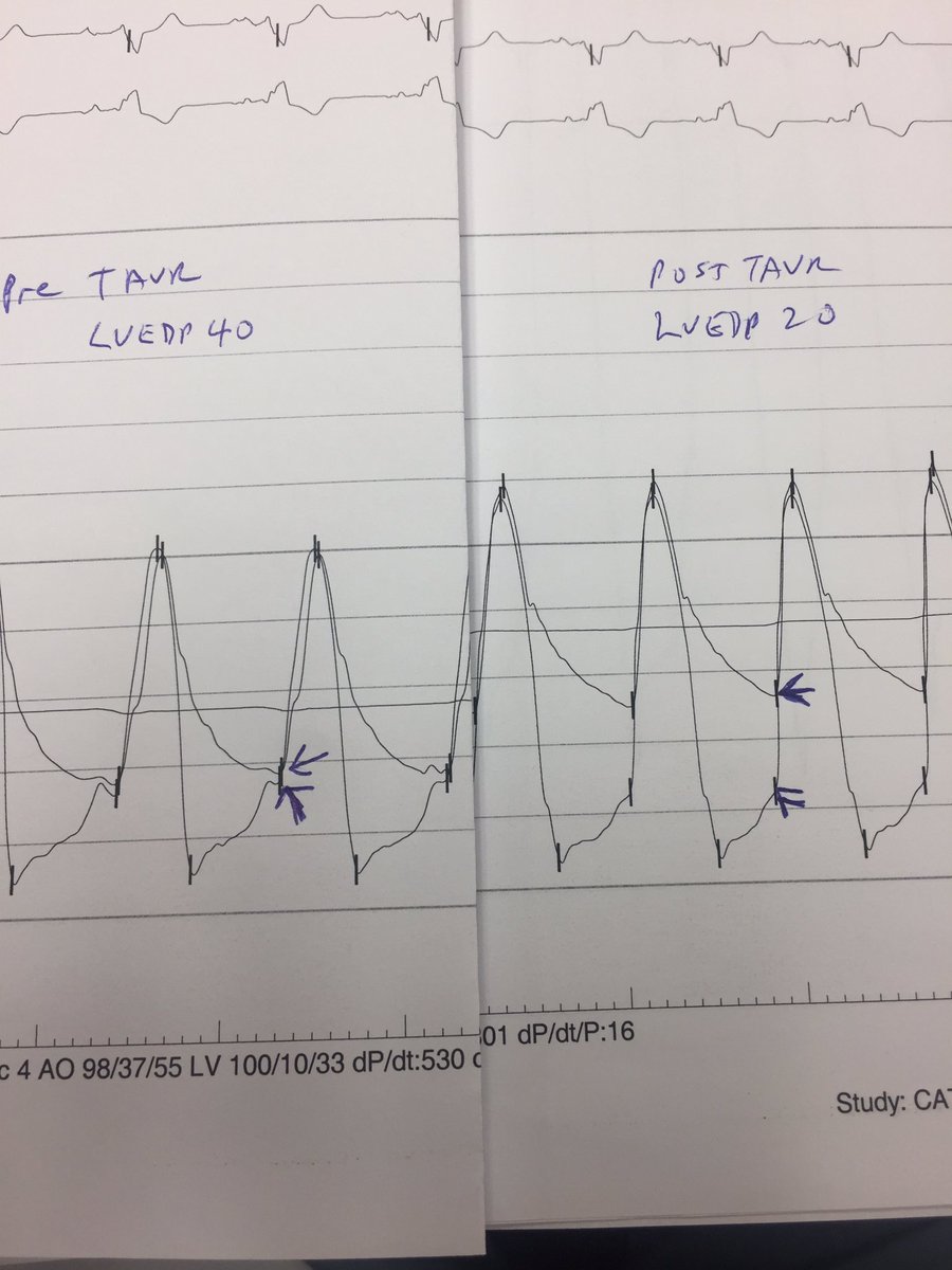 Amazing case of ER #TAVR, flail AVR leaflet w/wide open AR. Tracings tell it all! LVEDP 40 to 20!! And check out these videos...(1/3)