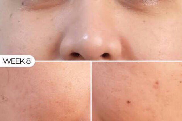 ‼️พร้อมส่ง‼️TheOrdinary niacinamide10%+zinc1%
•ช่วยให้รูขุมขนเล็กลง
•ลดรอยดำ-แดงจากสิว
•ควบคุมความมันส่วนเกิน
💥420 free ems💥